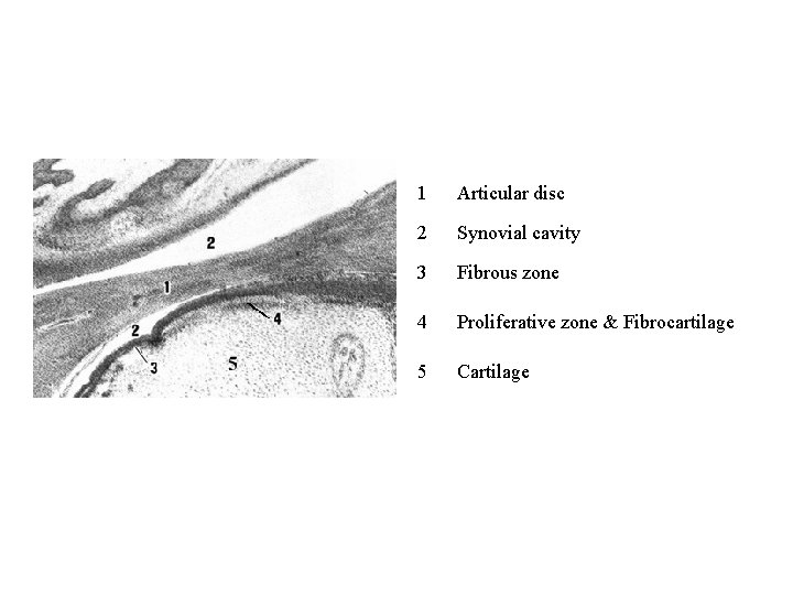 1 Articular disc 2 Synovial cavity 3 Fibrous zone 4 Proliferative zone & Fibrocartilage