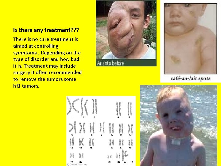 Is there any treatment? ? ? There is no cure treatment is aimed at