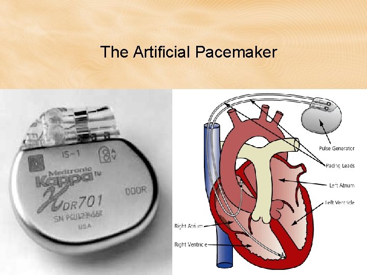 The Artificial Pacemaker The Artificial Pacemaker