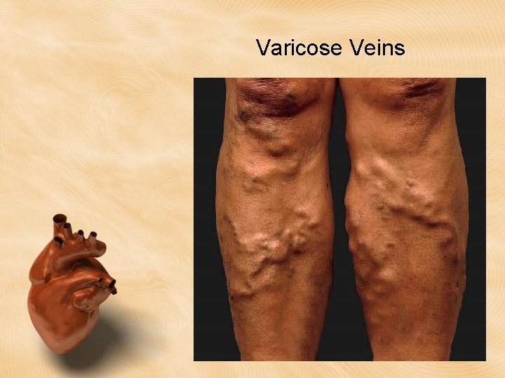 Varicose Veins Varicose Veins