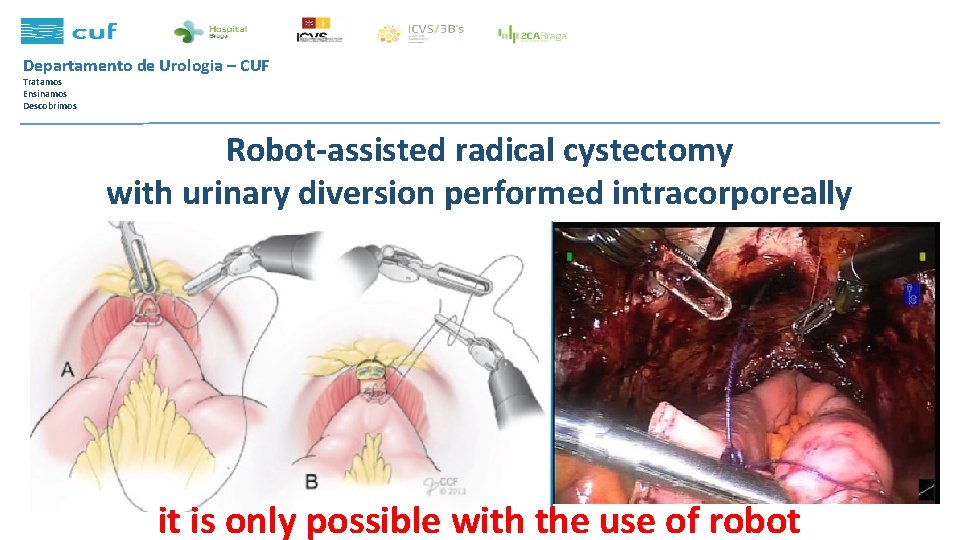 Departamento de Urologia – CUF Tratamos Ensinamos Descobrimos Robot-assisted radical cystectomy with urinary diversion