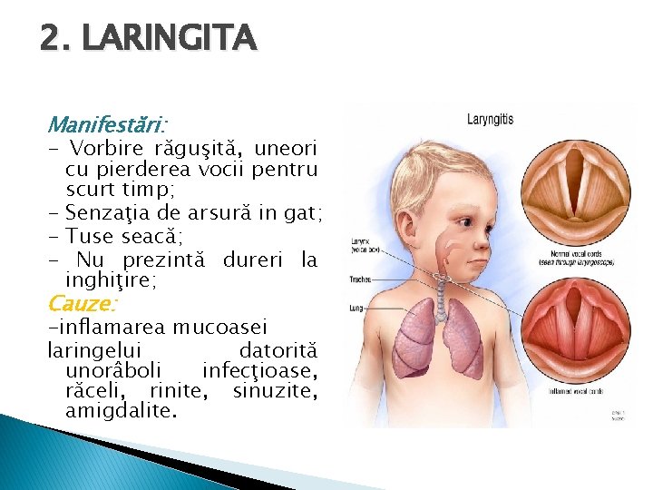 2. LARINGITA Manifestări: - Vorbire răguşită, uneori cu pierderea vocii pentru scurt timp; -