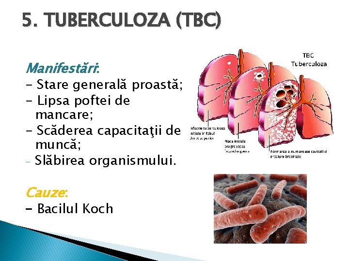 5. TUBERCULOZA (TBC) Manifestări: - Stare generală proastă; - Lipsa poftei de mancare; -