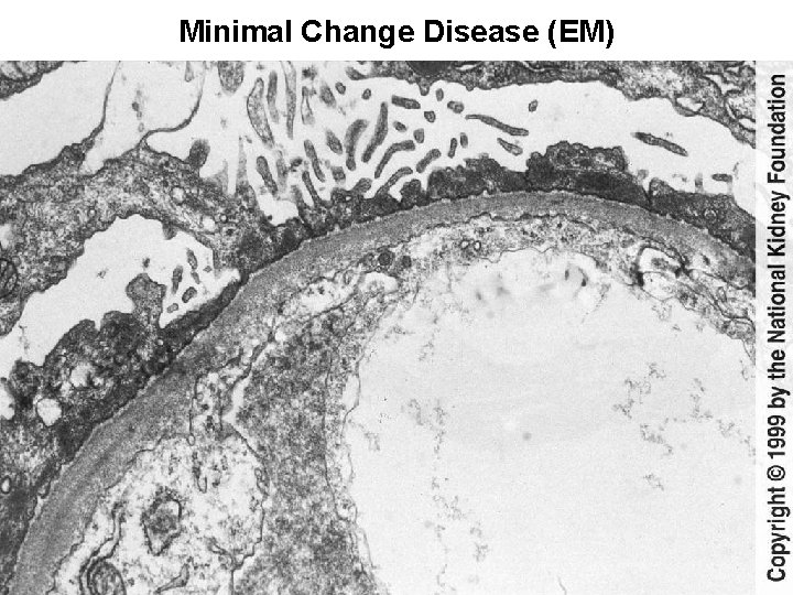 Minimal Change Disease (EM) 
