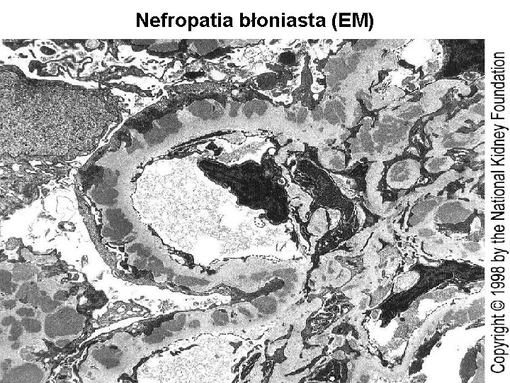 Nefropatia błoniasta (EM) 