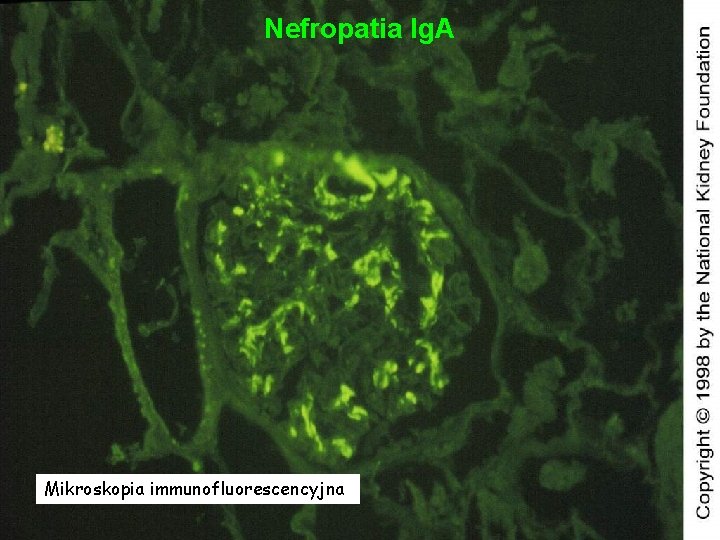 Nefropatia Ig. A Mikroskopia immunofluorescencyjna 