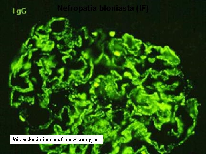 Nefropatia błoniasta (IF) Mikroskopia immunofluorescencyjna 