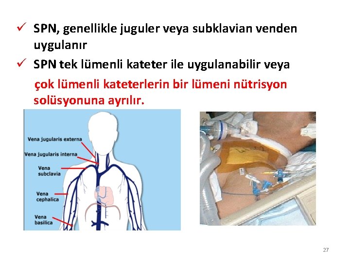 ü SPN, genellikle juguler veya subklavian venden uygulanır ü SPN tek lümenli kateter ile