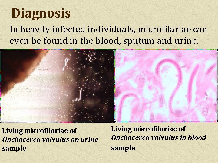 Diagnosis In heavily infected individuals, microfilariae can even be found in the blood, sputum
