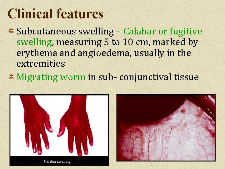 Clinical features Subcutaneous swelling – Calabar or fugitive swelling, measuring 5 to 10 cm,