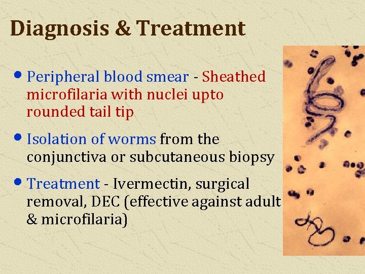 Diagnosis & Treatment • Peripheral blood smear - Sheathed microfilaria with nuclei upto rounded