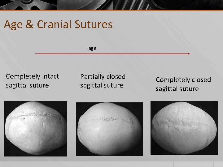 Age & Cranial Sutures age Completely intact sagittal suture Partially closed sagittal suture Completely