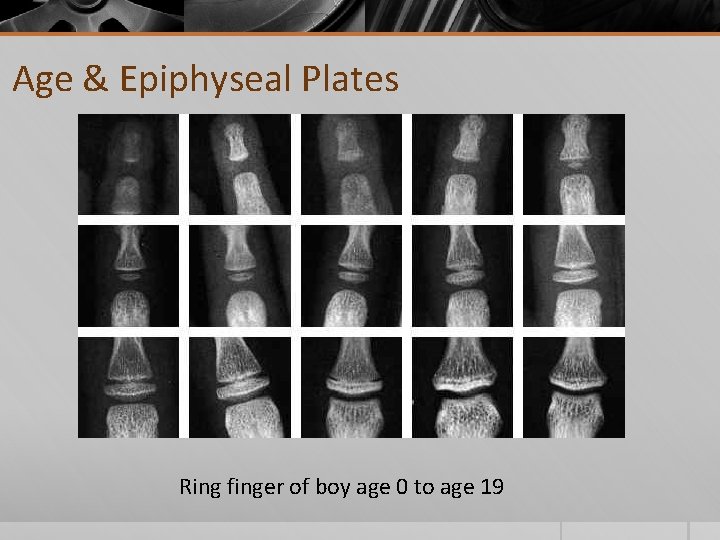 Age & Epiphyseal Plates Ring finger of boy age 0 to age 19 
