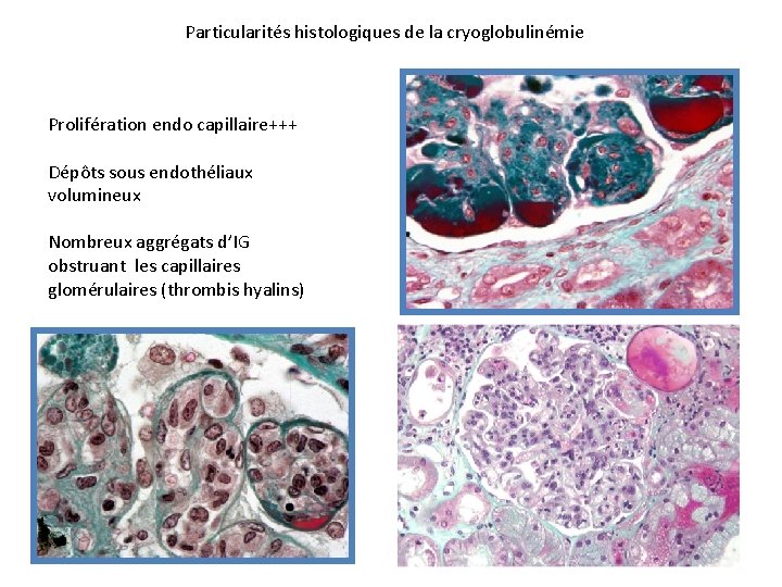 Particularités histologiques de la cryoglobulinémie Prolifération endo capillaire+++ Dépôts sous endothéliaux volumineux Nombreux aggrégats