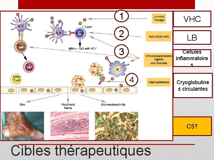 1 VHC 2 LB 3 Cellules inflammatoire s 4 Cryoglobuline s circulantes C 5?