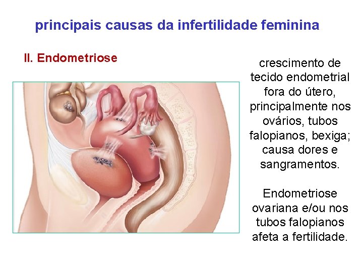 principais causas da infertilidade feminina II. Endometriose crescimento de tecido endometrial fora do útero,