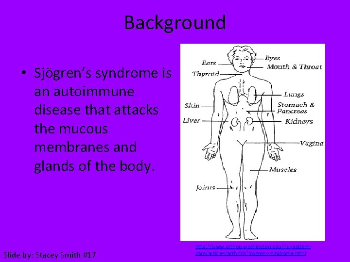 Background • Sjögren’s syndrome is an autoimmune disease that attacks the mucous membranes and