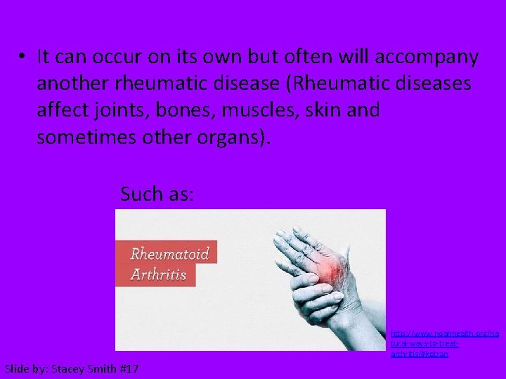  • It can occur on its own but often will accompany another rheumatic
