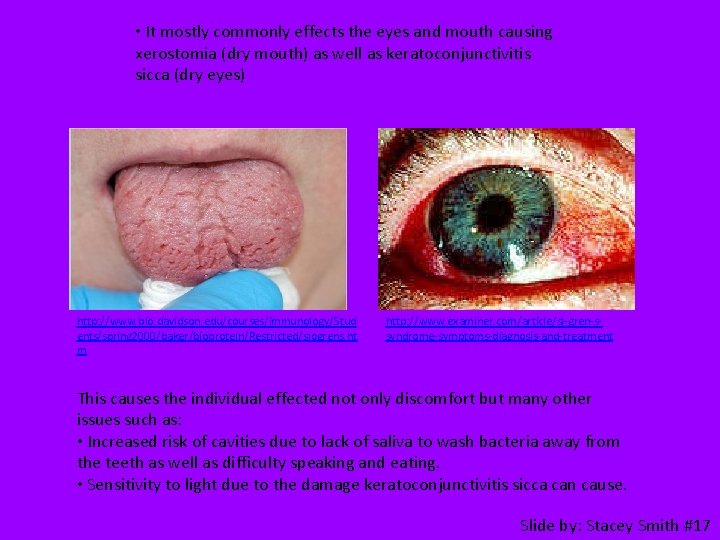  • It mostly commonly effects the eyes and mouth causing xerostomia (dry mouth)