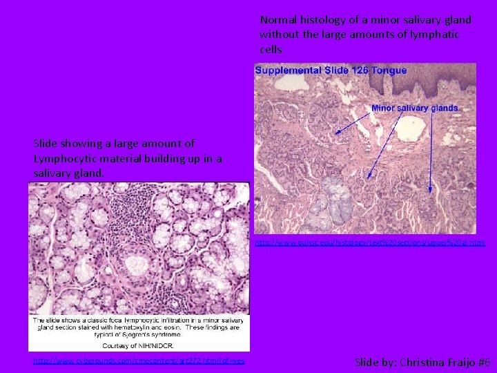 Normal histology of a minor salivary gland without the large amounts of lymphatic cells