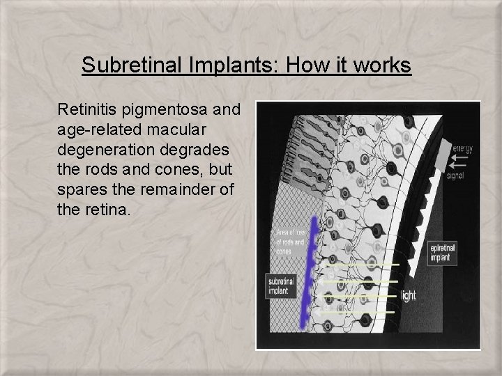 Subretinal Implants: How it works Retinitis pigmentosa and age-related macular degeneration degrades the rods