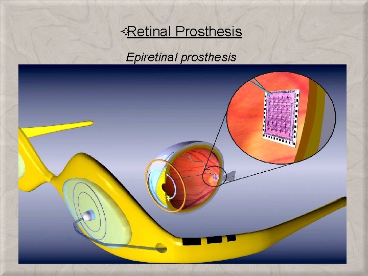 ²Retinal Prosthesis Epiretinal prosthesis 