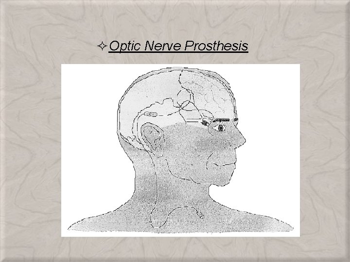 ²Optic Nerve Prosthesis 