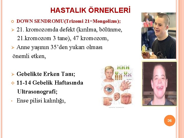 HASTALIK ÖRNEKLERİ DOWN SENDROMU(Trizomi 21=Mongolizm); 21. kromozomda defekt (kırılma, bölünme, 21. kromozom 3 tane),