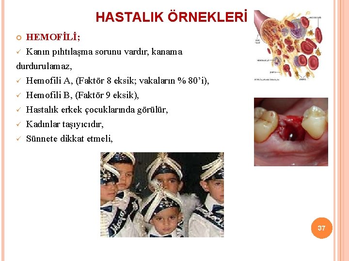 HASTALIK ÖRNEKLERİ HEMOFİLİ; ü Kanın pıhtılaşma sorunu vardır, kanama durdurulamaz, ü Hemofili A, (Faktör