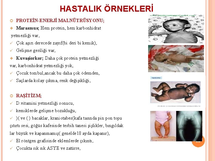 HASTALIK ÖRNEKLERİ PROTEİN-ENERJİ MALNÜTRÜSYONU; v Marasmus; Hem protein, hem karbonhidrat yetmezliği var, ü Çok