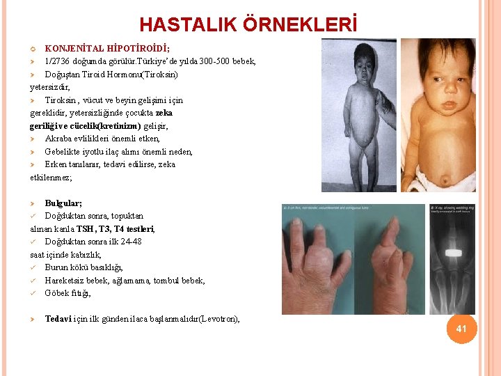 HASTALIK ÖRNEKLERİ KONJENİTAL HİPOTİROİDİ; Ø 1/2736 doğumda görülür. Türkiye’de yılda 300 -500 bebek, Ø
