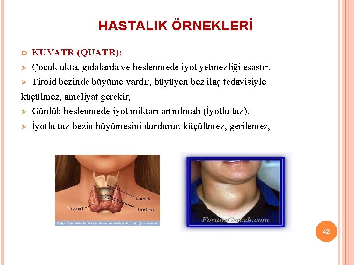 HASTALIK ÖRNEKLERİ Ø Ø KUVATR (QUATR); Çocuklukta, gıdalarda ve beslenmede iyot yetmezliği esastır, Tiroid