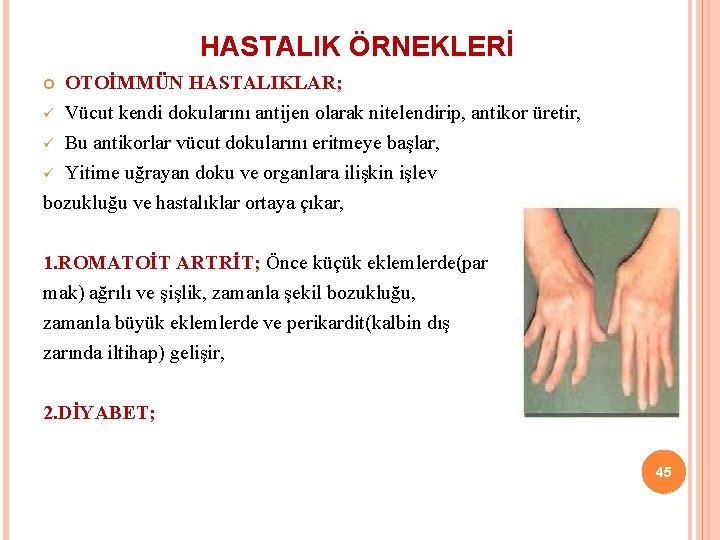 HASTALIK ÖRNEKLERİ OTOİMMÜN HASTALIKLAR; ü Vücut kendi dokularını antijen olarak nitelendirip, antikor üretir, ü