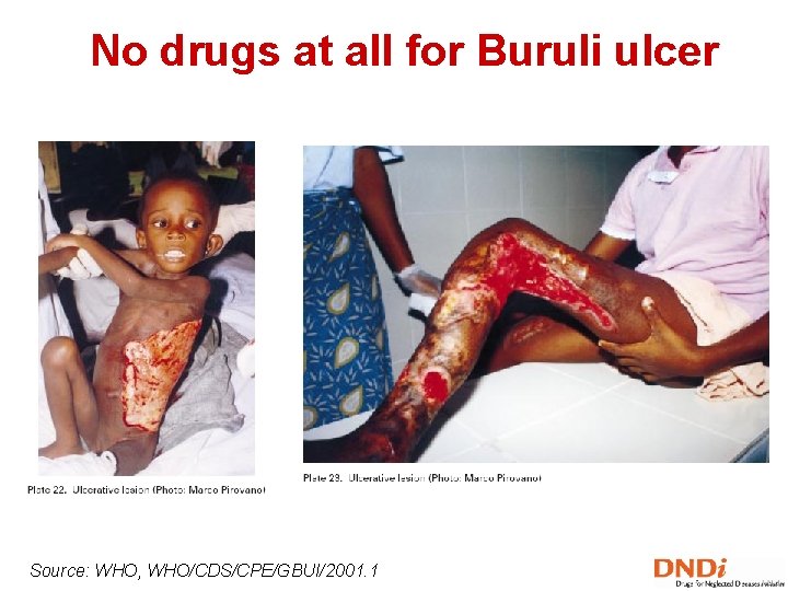No drugs at all for Buruli ulcer Source: WHO, WHO/CDS/CPE/GBUI/2001. 1 