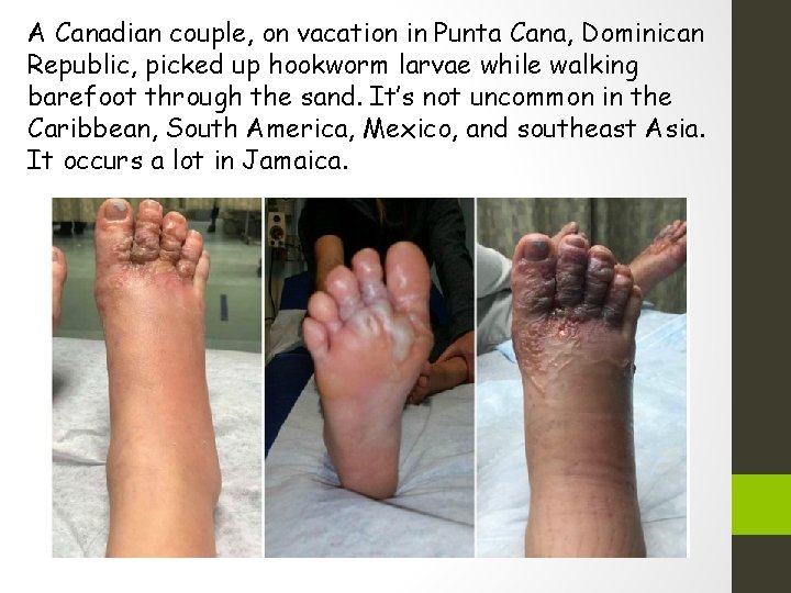 A Canadian couple, on vacation in Punta Cana, Dominican Republic, picked up hookworm larvae