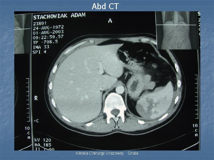 Abd CT Klinika Chirurgii Urazowej Grala 