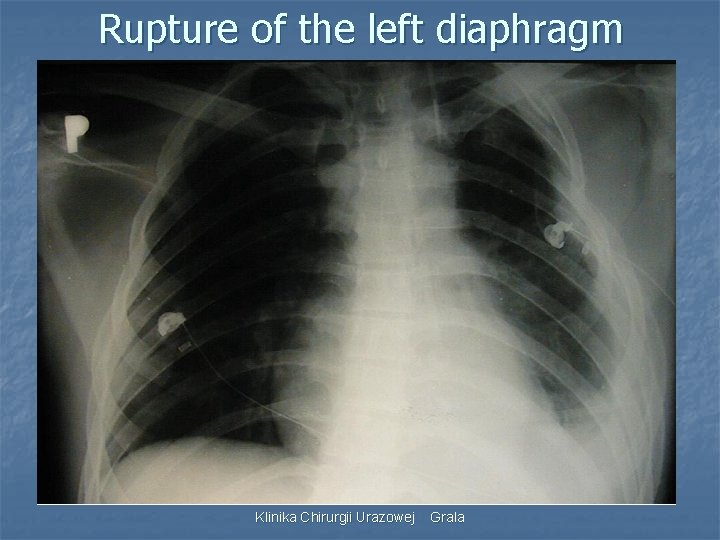 Rupture of the left diaphragm Klinika Chirurgii Urazowej Grala 