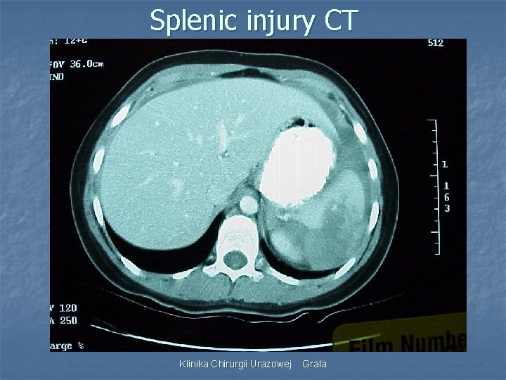 Splenic injury CT Klinika Chirurgii Urazowej Grala 