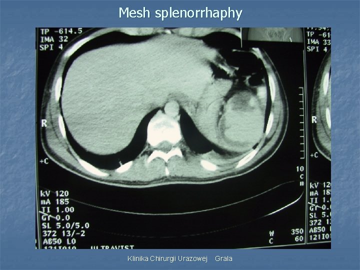 Mesh splenorrhaphy Klinika Chirurgii Urazowej Grala 