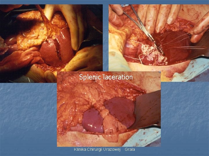 Splenic laceration Klinika Chirurgii Urazowej Grala 