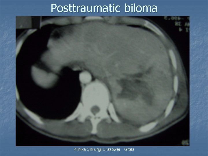 Posttraumatic biloma Klinika Chirurgii Urazowej Grala 