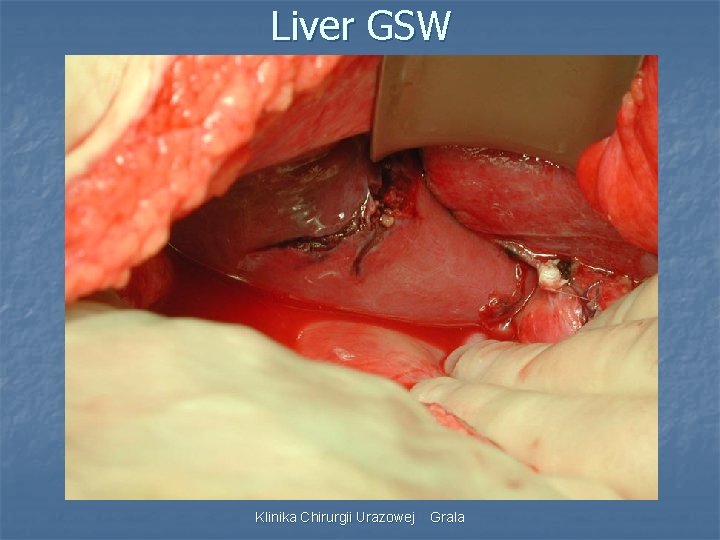 Liver GSW Klinika Chirurgii Urazowej Grala 