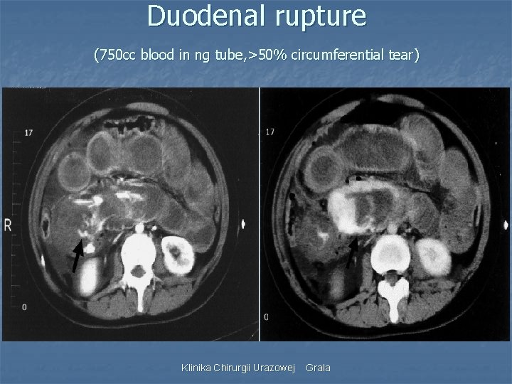 Duodenal rupture (750 cc blood in ng tube, >50% circumferential tear) Klinika Chirurgii Urazowej