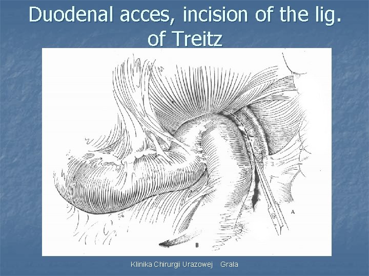 Duodenal acces, incision of the lig. of Treitz Klinika Chirurgii Urazowej Grala 