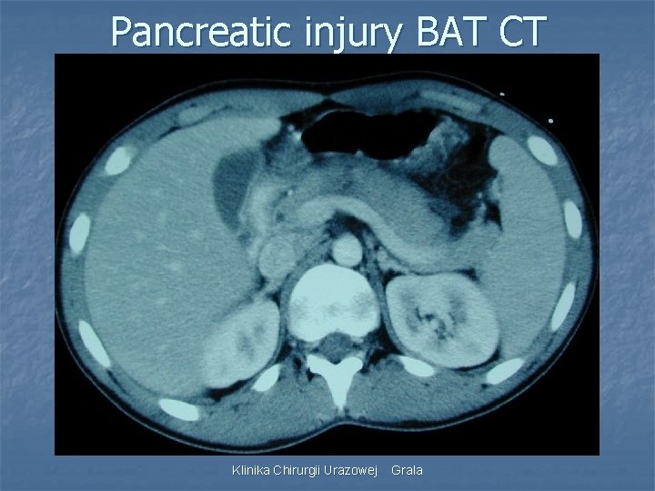Pancreatic injury BAT CT Klinika Chirurgii Urazowej Grala 