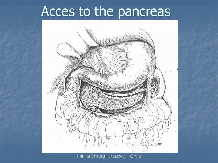 Acces to the pancreas Klinika Chirurgii Urazowej Grala 