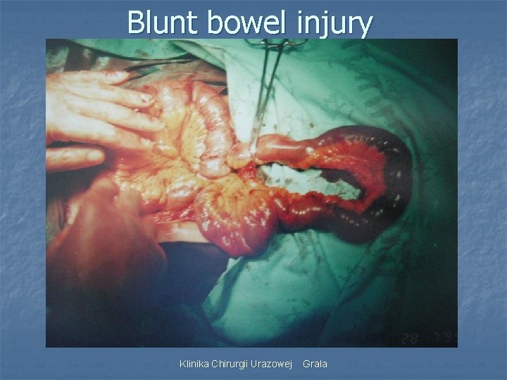 Blunt bowel injury Klinika Chirurgii Urazowej Grala 