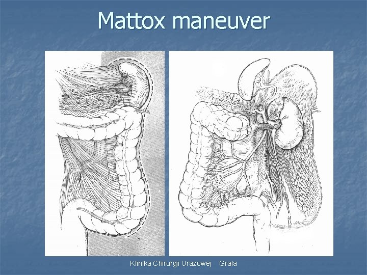 Mattox maneuver Klinika Chirurgii Urazowej Grala 