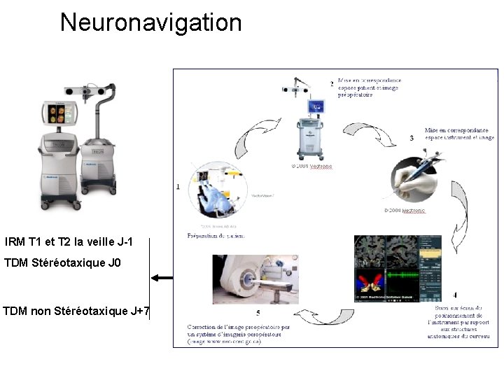 Neuronavigation IRM T 1 et T 2 la veille J-1 TDM Stéréotaxique J 0