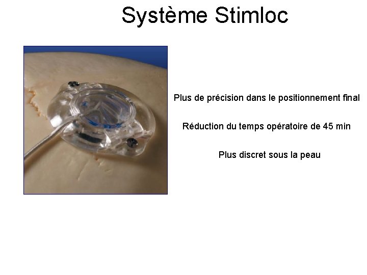 Système Stimloc Plus de précision dans le positionnement final Réduction du temps opératoire de